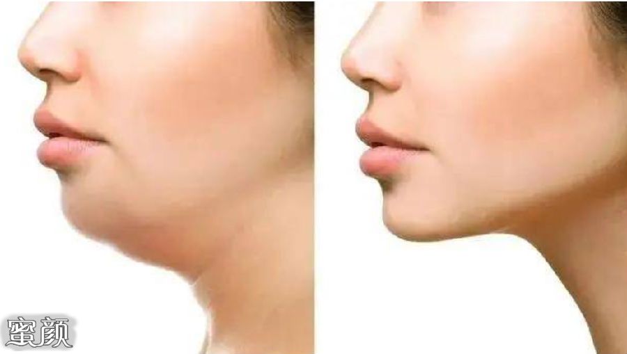 凸嘴矫正手术应该怎样做？复杂的凸嘴可以调节上颚和下巴位置